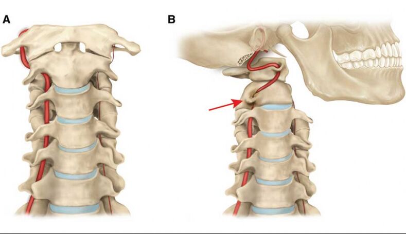 Vertebral arterin seyri