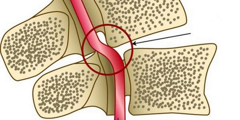 Vertebral instabilite nedeniyle vertebral arterin deformasyonu